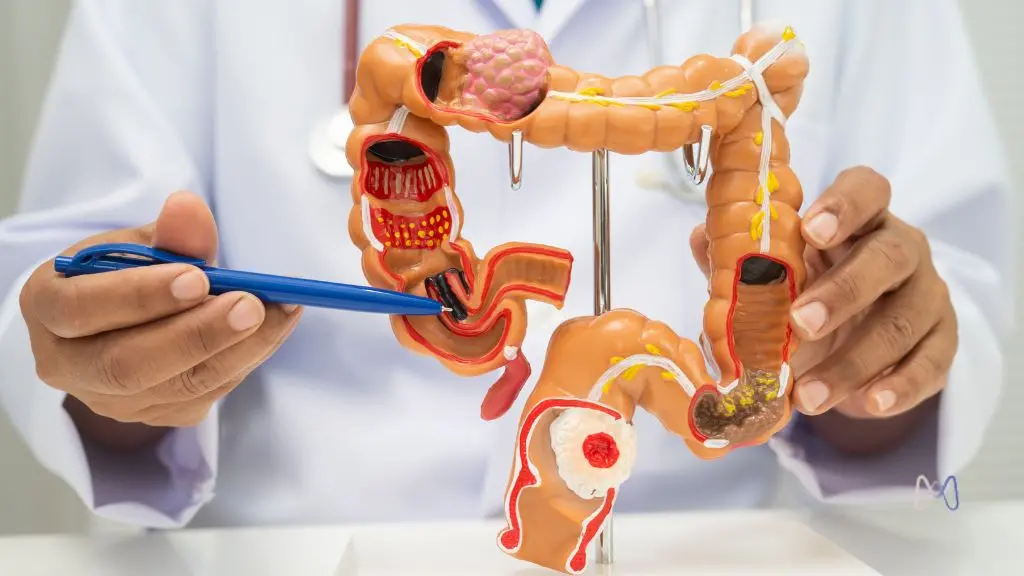 Endometriose intestinal: sintomas, diagnóstico e tratamento